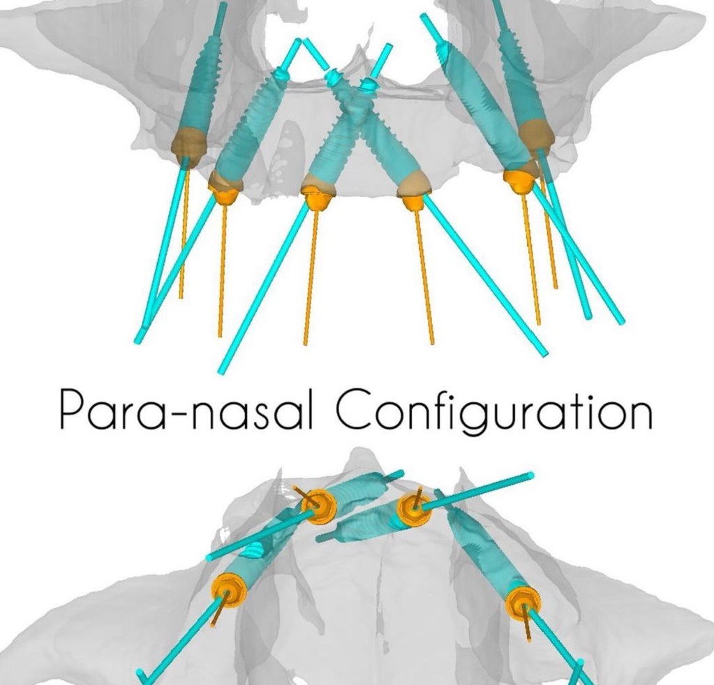 Para-nasal Configuration