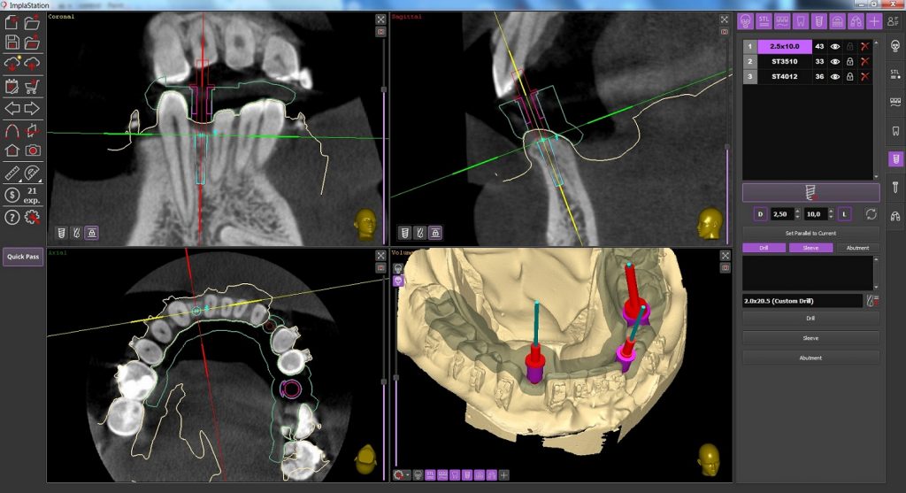 Implant Placement On Restricted Mesiodistal Space: Case Report