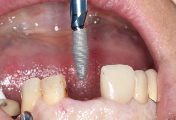 Southern Implants Co-Axis INVERTA implant
