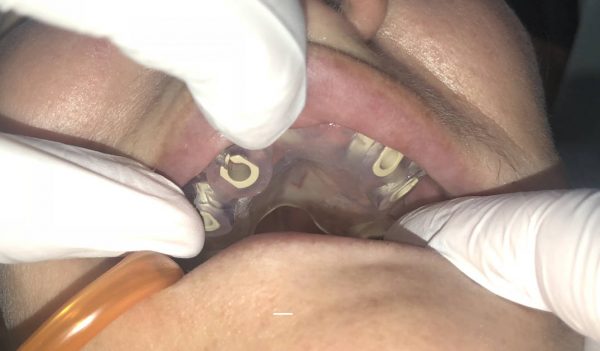 dental implant surgical procedure with a surgical guide