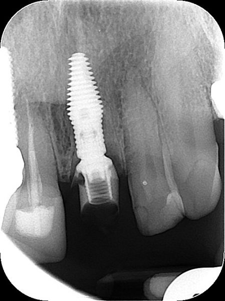 post placement pre apical X-Ray of the implant