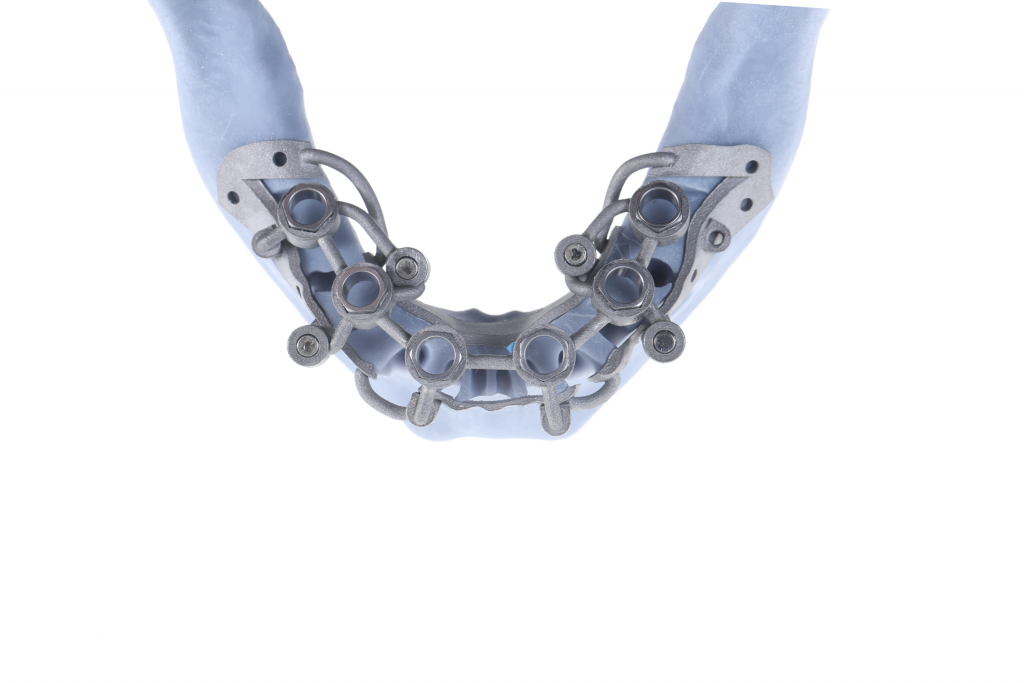 All-on-Six Full-Arch Immediate loading Implant Rehabilitation Following Guided Alveolar Ridge Reduction: A Case Study