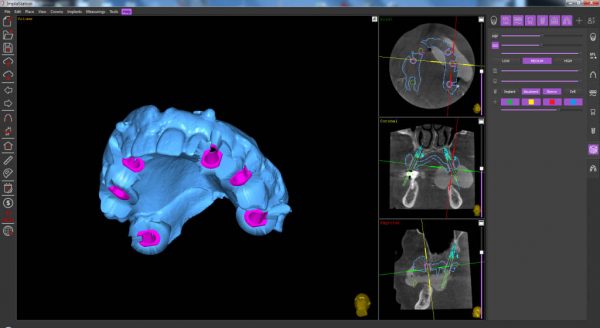 surgical guide based on the prosthesis scan 2